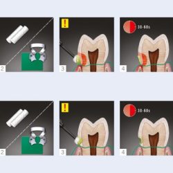 Gluma desensitizer instructions for use