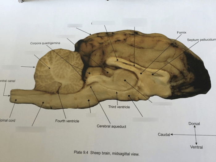 Cerebral aqueduct nervous labeled ventricle cerebrum lateral