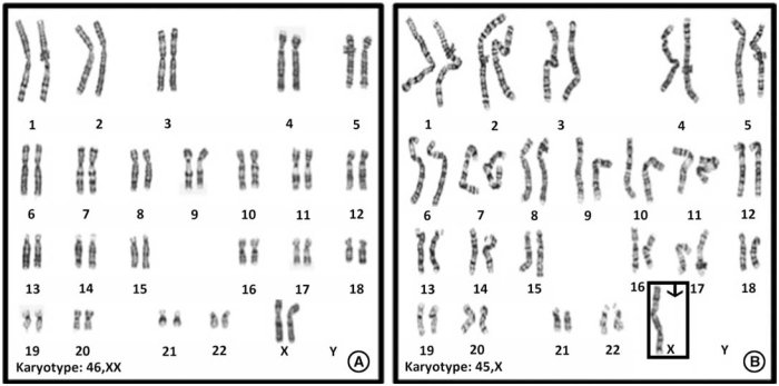 Describe an individual with the karyotype shown.